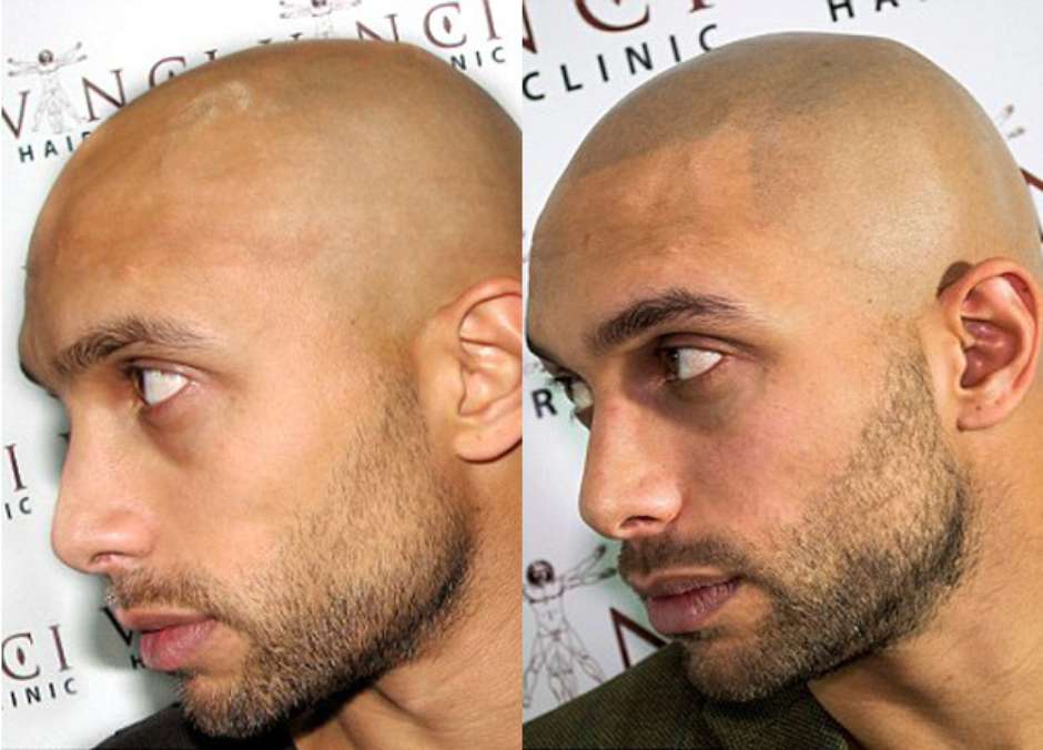 Homem calvo faz tatuagem no lugar do cabelo e viraliza na web: 'Lindo  demais