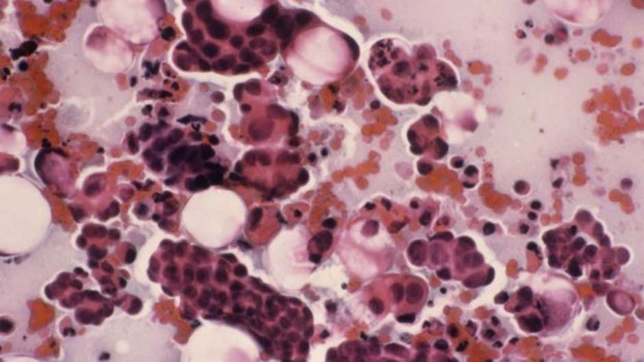 manchas en el utero por vph