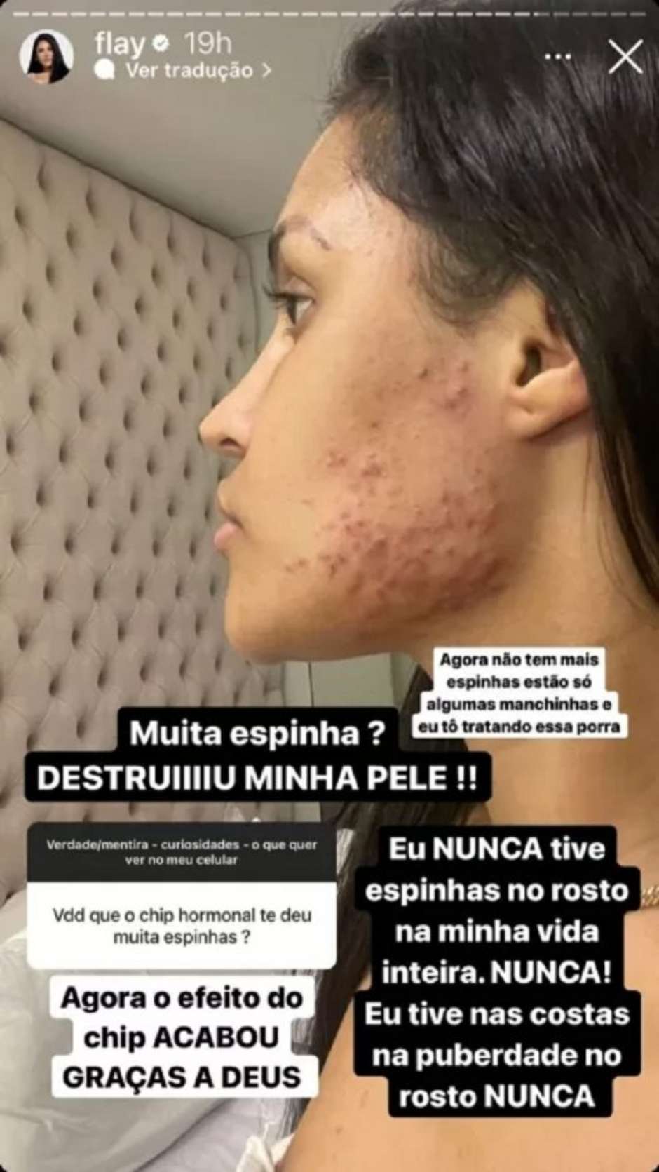 Flay exibe rosto coberto de acne após implante hormonal; entenda o 