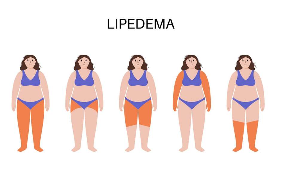 Lipedema: o que é, sintomas, causas e tratamento - Tua Saúde
