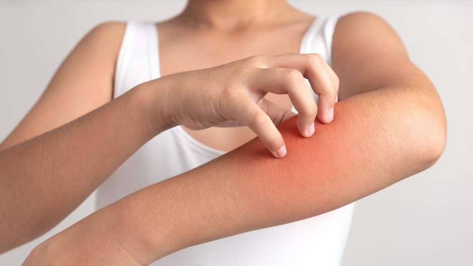 Alergias: 5 doen&ccedil;as de pele mais comuns no ver&atilde;o