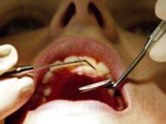 1. Antes de convertirse en un punto negro, la caries se caracteriza por una mancha blanca en la superficie del esmalte de los dientes. En esa fase, el dentista puede detectarla y contener su avance sin comprometer el diente.