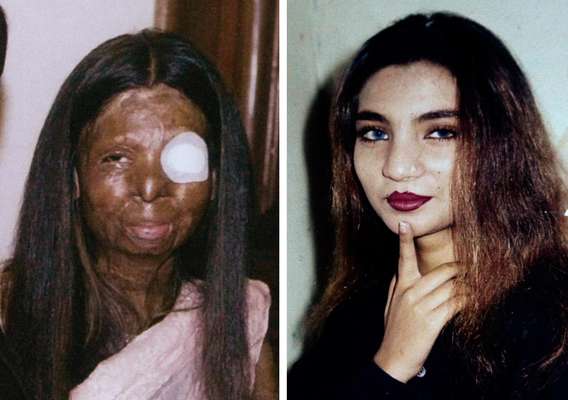 Dos fotografías de Fakhra Younus antes y después de que le arrojara ácido en el rostro su esposo, un ex legislador e hijo de un poderoso polìtico hace doce años. Younus fue sometida a más de tres docenas de cirugías para repararle el rostro y el cuerpo. finalmente la mujer de 33 años decidió sucidarse, lanzándose de un sexto piso en Roma donde recibía tratamiento.