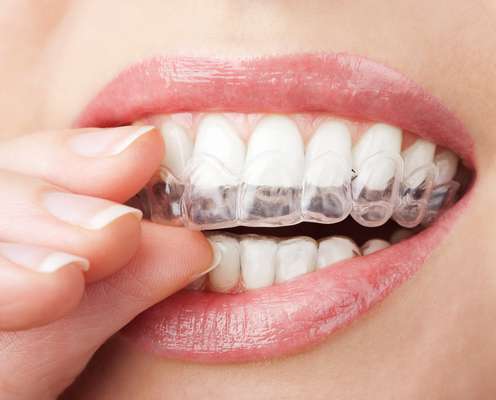 Proteja sus dientes y no deje que el bruxismo interfiera durante sus horas de sueño.