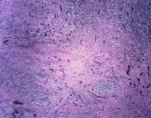 La tuberculosis es la segunda causa mundial de mortalidad, después del sida, causada por un agente infeccioso. El agente es Mycobacterium tuberculosis, una bacteria que casi siempre afecta a los pulmones. La afección es curable y se puede prevenir. A continuación, conoce un poco más de esta enfermedad gracias a la información que proporciona la Organización Mundial de la Salud (OMS).