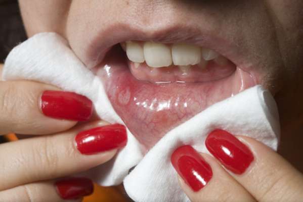 O que são aftas? Aftas são ulceras rasas de aproximadamente 1 cm de diâmetro que aparecem na cavidade oral. São lesões benignas, extremamente dolorosas, que acometem cerca de 20% ou mais da população mundial. Elas podem ser brancas ou amareladas e podem aparecer na mucosa bucal, língua, gengiva, diz a estomatologista, Carméli Sampaio, consultora científica da Associação Brasileira de Odontologia (ABO).