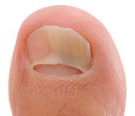 Infecções causadas por fungos, as micoses são problemas de saúde comuns. Esses microorganismos existem no corpo humano e no meio ambiente e vivem em locais úmidos. A melhor forma de prevenir uma micose é cuidar da higiene e evitar a exposição a locais ou situações que possam favorecer a infecção. Micoses exigem tratamento prolongado e persistente. Todos sofrem de micose pelo menos uma vez na vida e pode acontecer por vários fatores. Veja alguns tipos mais comuns