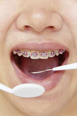 Usar aparatos dentales puede ser una solución para numerosos problemas en la boca. Por medio del uso de brackets y placas dentales es posible alinear las piezas dentales, corregir la mordedura y hasta regular desajustes en la mandíbula.