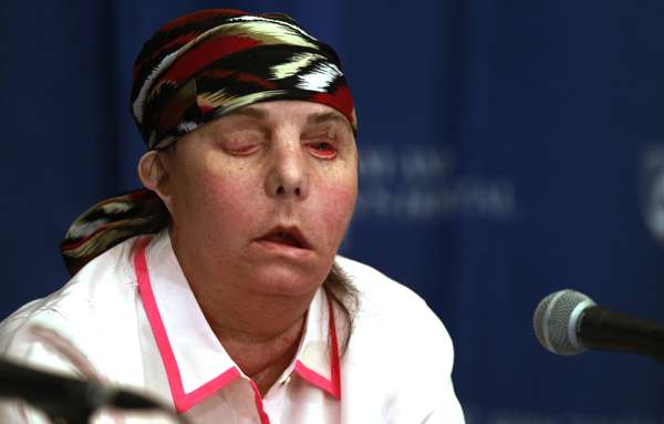 Carmen Balndin Tarleton, 44 anos, sofreu um ataque do marido em 2007 e teve 80% do corpo queimado. Seis anos depois ela mostrou a jornalistas sua nova face, após passar por um transplante de rosto nos Estados Unidos