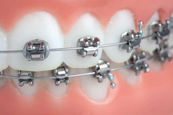 A força aplicada pelo aparelho provoca a movimentação dentária. Isso é possível por conta de uma remodelação óssea, iniciada a partir do processo inflamatório no periodonto tecidos que revestem e envolvem o dente. Todo processo inflamatório está associado a algum grau de desconforto e dor, cuja intensidade está relacionada ao limiar de dor de cada paciente