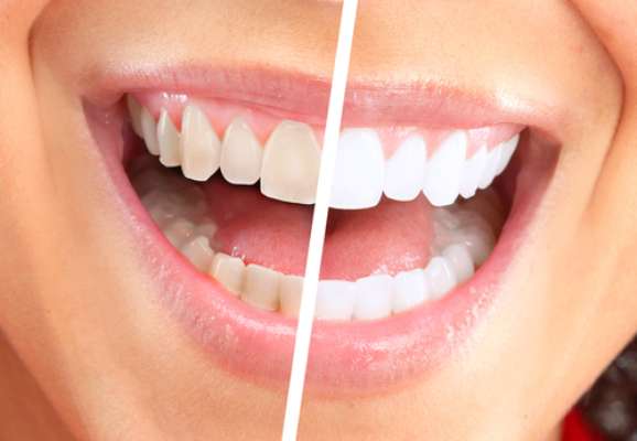 O uso de kits clareadores de forma exagerada ou sem orientação profissional pode causar danos à saúde oral do usuário, inclusive, lesões cancerígenas