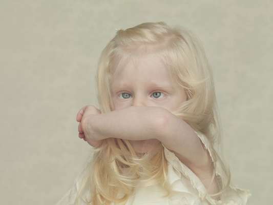 O albinismo é uma condição genética que se caracteriza pela falta de melanina no corpo. Sem ela, os indivíduos apresentam pele extremamente branca e olhos e cabelos claros. Mesmo assim, você sabia que afrodescendentes podem ser albinos?