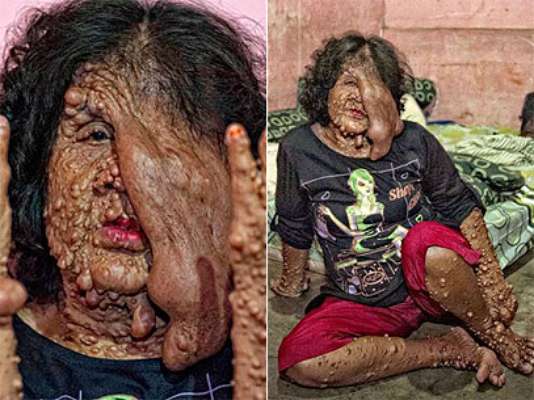 Sarotin, de 46 anos, foi obrigada a deixar o vilarejo onde morava na Indonésia após sofrer de uma condição médica que deixou seu corpo coberto de tumores