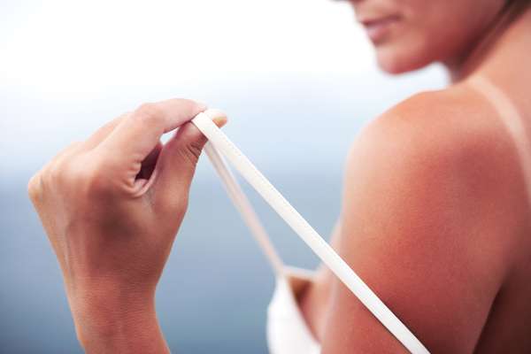 Para acalmar a pele, o mais indicado é aplicar uma boa dose de loção pós-sol sobre a área afetada