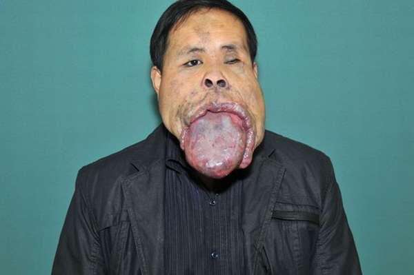 O chinês Wang Youping, 34 anos, não consegue fechar a boca desde os 13 anos de idades e a culpa é do tamanho de sua língua. O membro tem 25 centímetros de extensão, 10 centímetros de largura e 7 de grossura. Em 2012, ele deu início a uma série de operações que durariam três anos, a fim de encurtar o membro.