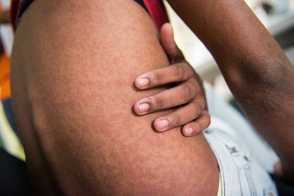 A Febre Chikungunya, surgida nos anos 50 no continente africano, causa febre alta e irritações na pele