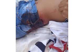 Indígena ferida durante confronto com policiais militares em Mato Grosso do Sul.