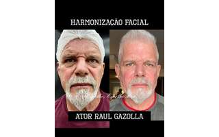 Raul Gazolla adere à harmonização facial e mostra antes e depois: 'Sempre  lindo' - Revista Marie Claire