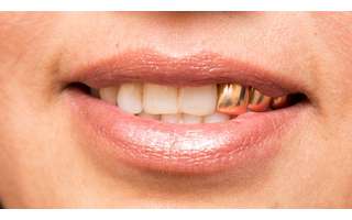 Gold teeth require specialized care and follow-up -