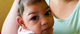 Entre 2015 e 2016, cerca de 3 mil crianças nasceram com microcefalia, a maioria delas na empobrecida região Nordeste