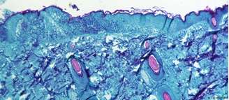 Tipo de erupção cutânea causada pelo vírus, vista ao microscópio