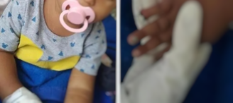 Bebê tem parte do dedo amputada após erro de enfermeira
