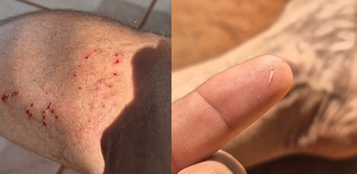 Montagem com imagens do local da mordida e do dente da sucuri que ficou preso em Rafael