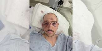 Jadon partilhou que teve medo de morrer, dado a gravidade de seus ferimentos, mas suas filhas o fizeram lutar pela vida