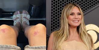 Heidi mostrou os joelhos machucados por roupa que usou no Grammy 2026