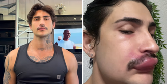 Influencer Ken de CG precisou ser internado após espremer uma espinha