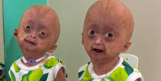 Elis e Eloá foram diagnosticadas com progéria aos 7 meses de idade