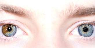 Na maioria dos casos, a condição é benigna e não afeta a visão, especialmente quando é congênita – Wikimedia Commons/Tazztone