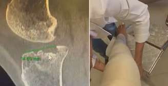 Homem pisou no joelho de uma das passageiras, causando uma fratura; ela vai passar por cirurgia