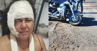 Empresária leva mais de 60 pontos no rosto e quebra braço em acidente de moto 