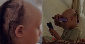 Criança fica careca após choque nervoso provocado por guerra em Gaza 