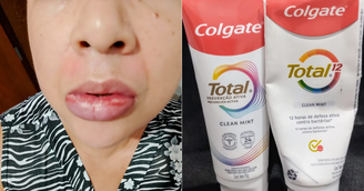 Educadora lábios após uso de creme dental interditado pela Anvisa