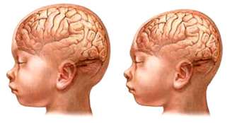Ilustração da esquerda mostra criança com tamanha normal de cabeça. À direita, criança com microcefalia