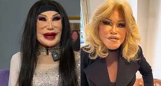 Lyn May e Jocelyn Wildestein: plásticas sucessivas resultaram em aparência nada natural