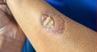 Mordida deixou marca no braço da vice-diretora