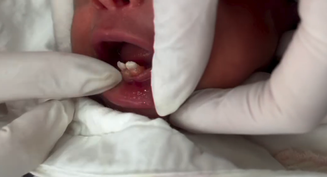 Bebê nasce com dentes no ES e passa por cirurgia para retirada; a cirurgiã-dentista Julia Emery revelou que o caso é considerado raro