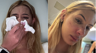 Vitória Bianchessi levou soco de agressor, a quem ela acusa de transfobia