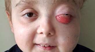 Matheus, 12 anos, enfrenta batalha contra tumor raro e precisa da sua ajuda no tratamento câncer infantil