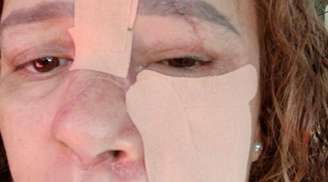 A luta corajosa de Agda pela recuperação facial após um grave acidente de bicicleta