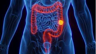 Aumento proporcional de casos de tumor no intestino entre mais jovens chamou a atenção de cientistas
