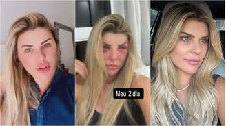 Antes e depois da ex-BBB Íris Stefanellli após lifting facial