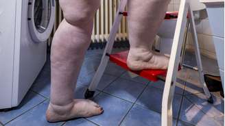 Embora os primeiros relatos da doença sejam datados dos anos 1940, apenas em 2022 o lipedema passou a ter um código próprio no Cadastro Internacional de Doenças (CID)