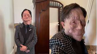 O ator Adam Pearson convive com um tipo de neurofibromatose.
