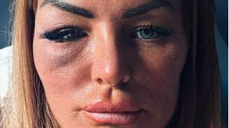 Anne Marie Boyle acabou com um osso malar quebrado, lesão cerebral e um trauma duradouro