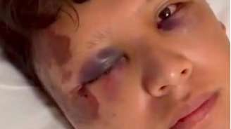 O turista mexicano Kevin Jonoel teve graves hematomas nos olhos e em todo o rosto.
