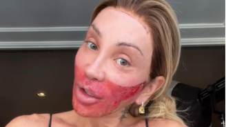 Maya Massafera aparece com o rosto queimado